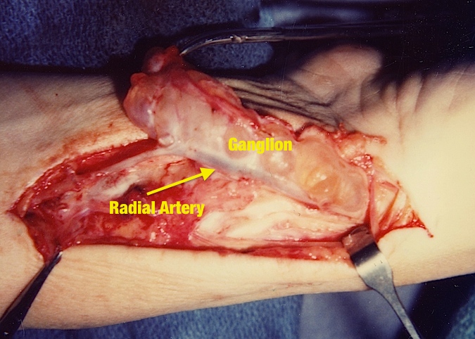 Ganglion Wrist Hand Fingers Hand Surgery Resource